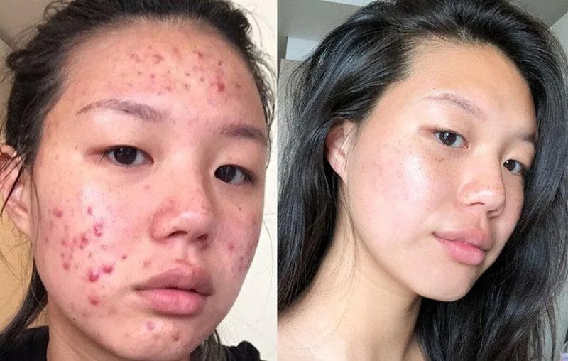 lấy nhân mụn chuẩn y khoa