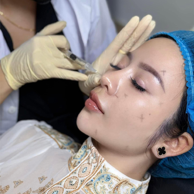 Địa chỉ tiêm filler fullface giá tốt tại TPHCM