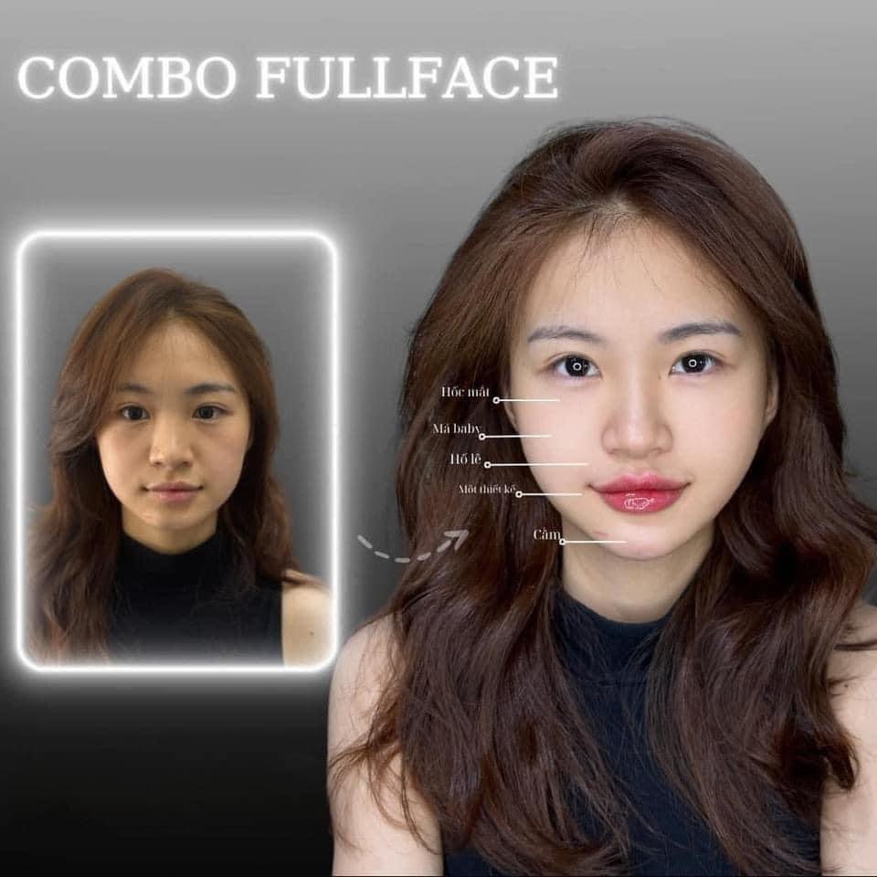 tiêm filler fullface