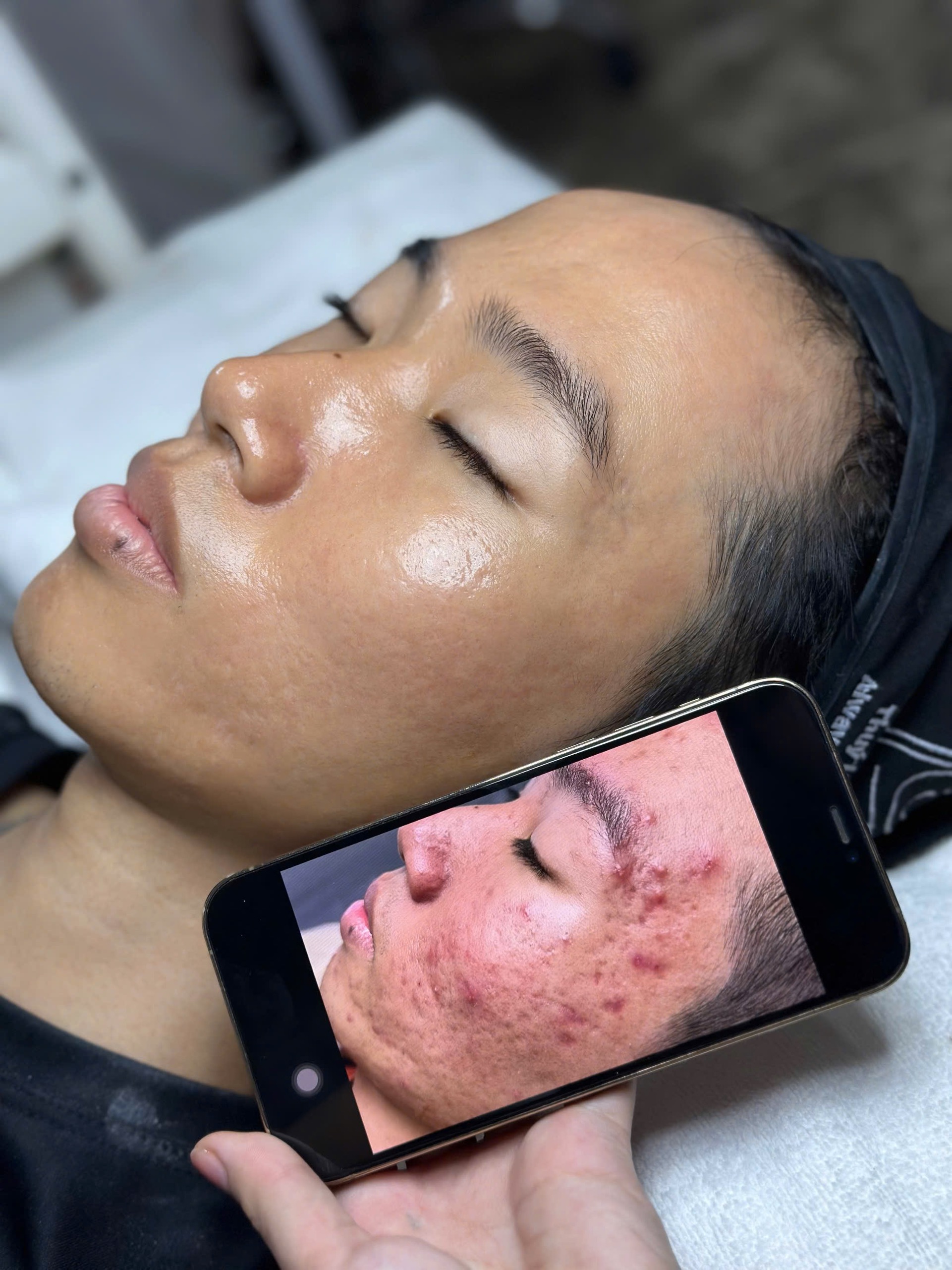 Trị sẹo rỗ bằng laser