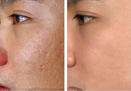 Trị sẹo rỗ