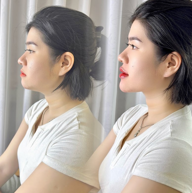tiêm filler fullface