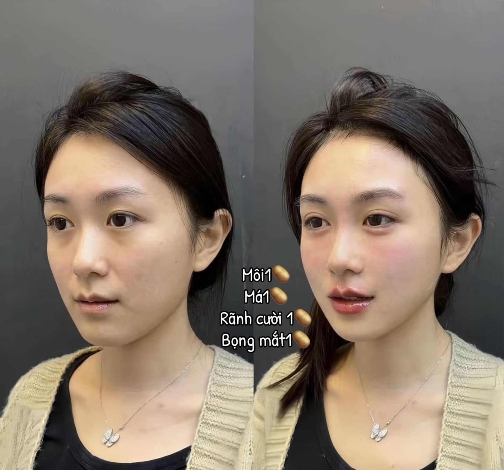 tiêm filler fullface