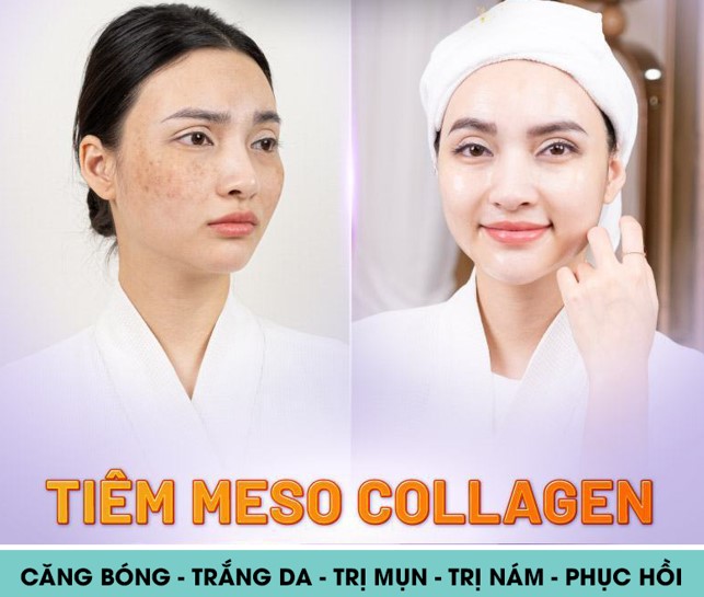 Tiêm meso trị thâm nám
