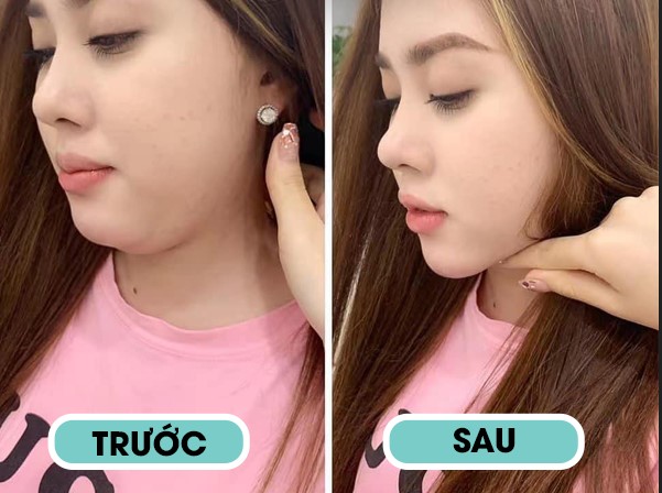 Dịch vụ tan mỡ