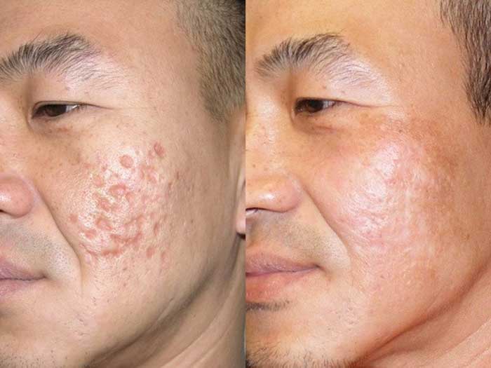Trị sẹo rỗ